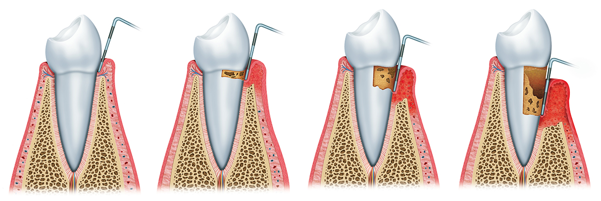 LIMPIEZA DENTAL ZARAGOZA
