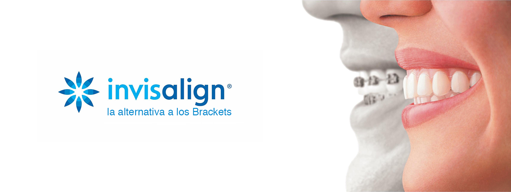 Implantes Dentales Zaragoza Dentistas Zaragoza Clínica Dental ZOE