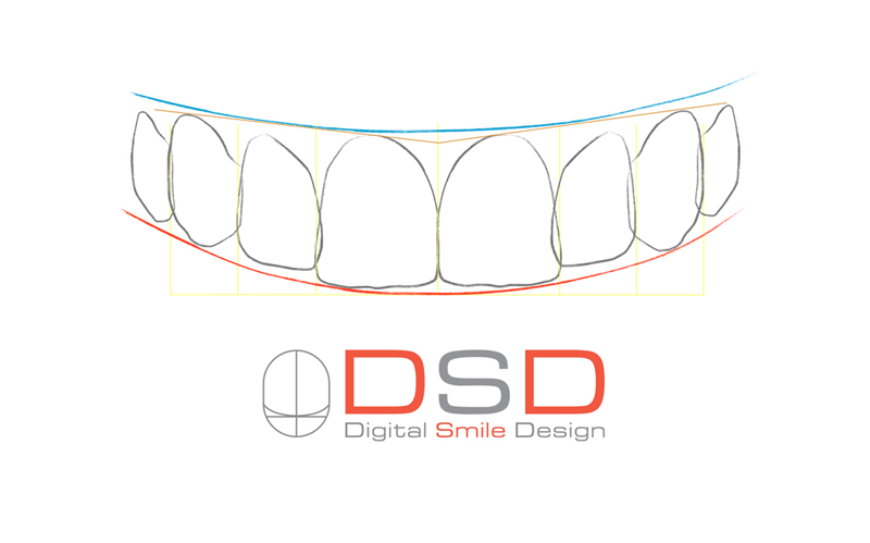Diseño Sonrisa DSD