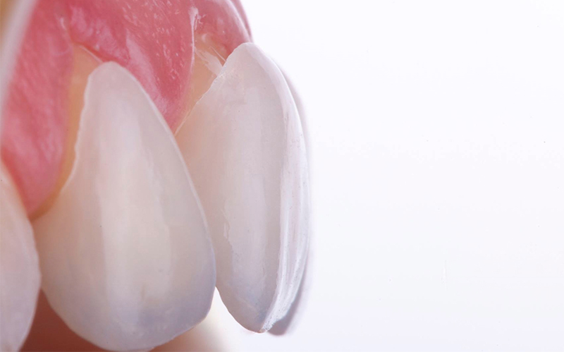 Carillas de porcelana