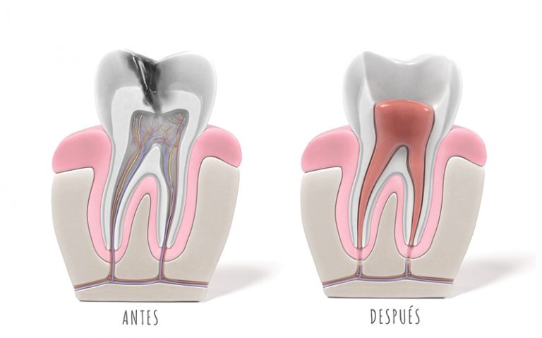 Endodoncia con Microscopio Dental