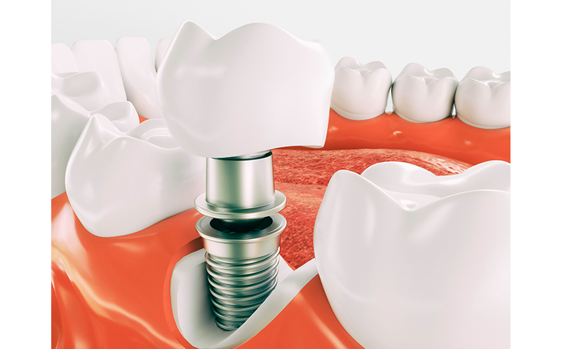 Implantes dentales de carga inmmediata