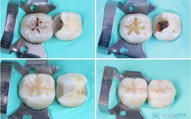 Incrustaciones Dentales