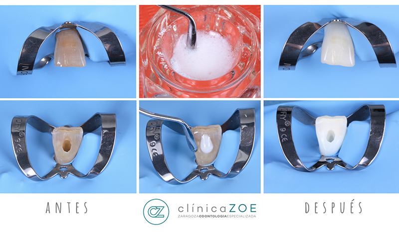 Blanqueamiento Dental Interno