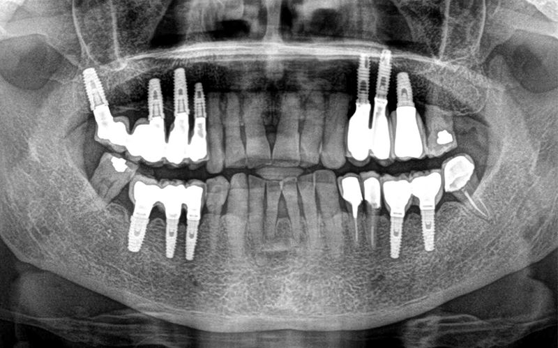 Mantenimiento Implantes Dentales