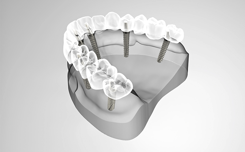 Rehabilitación Oral Completa