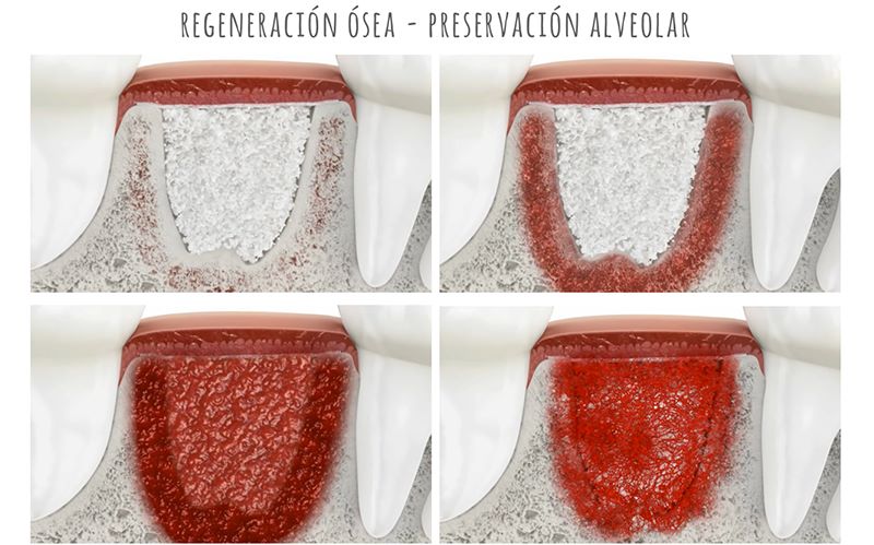 Regeneración Ósea