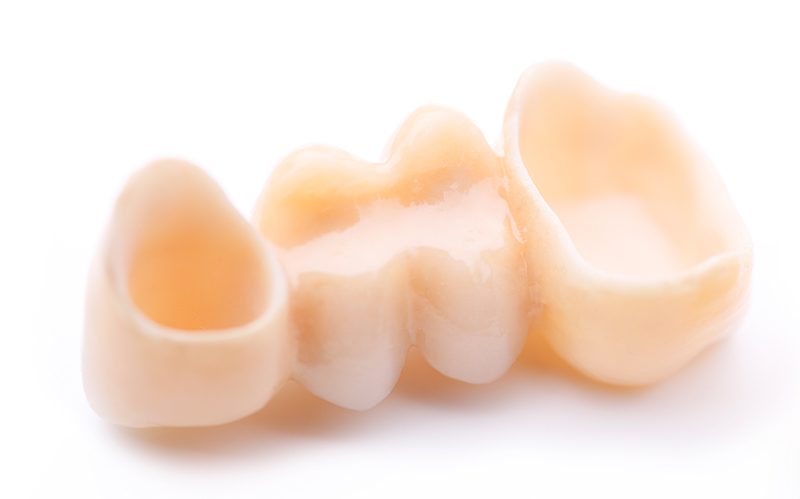Puentes Dentales Fijos