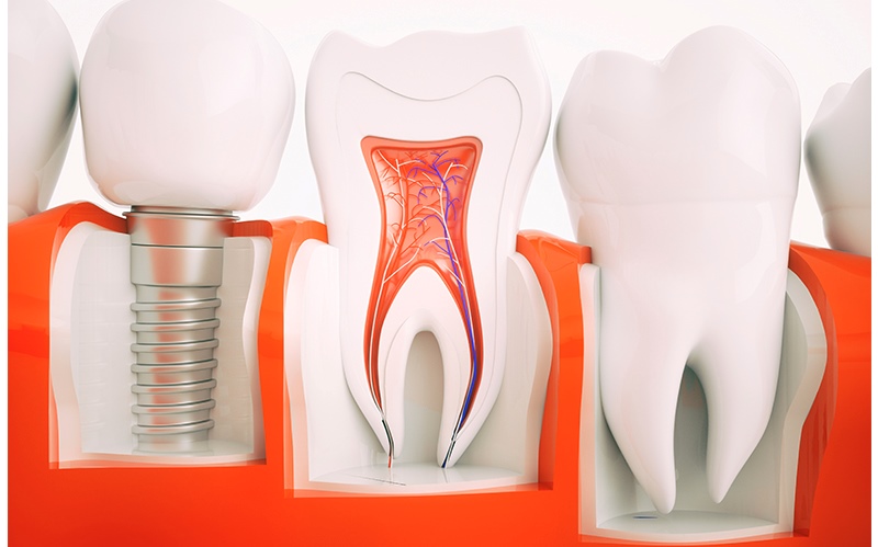 Tratamiento de Periimplantitis