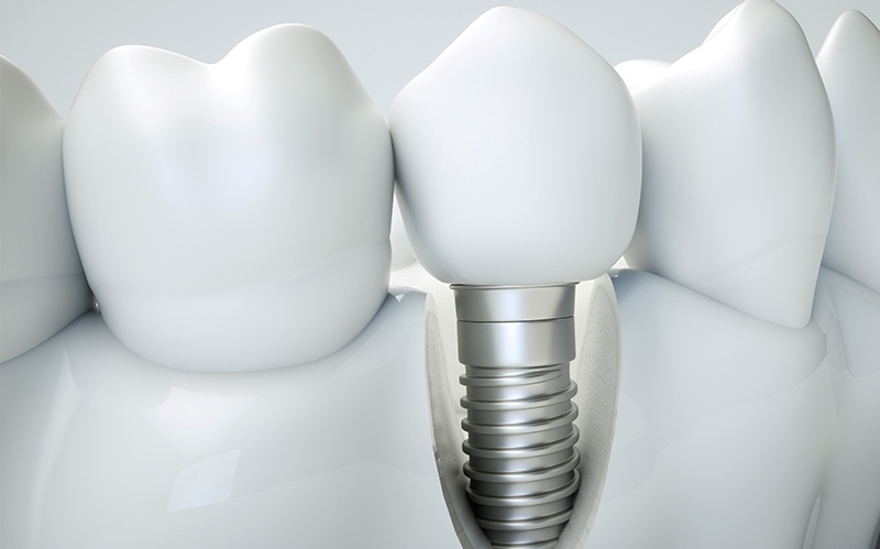 Tratamiento de Periimplantitis