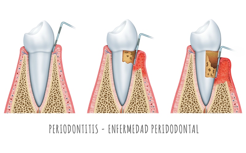 Periodontitis
