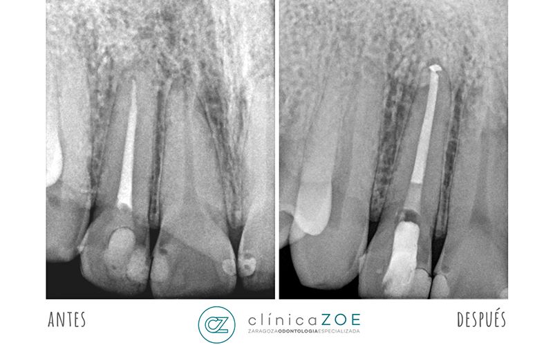 Reendodoncia