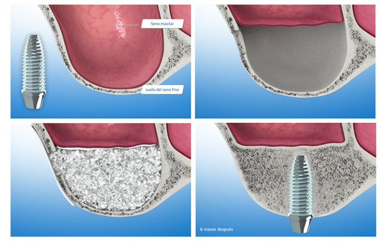 Elevación de seno maxilar