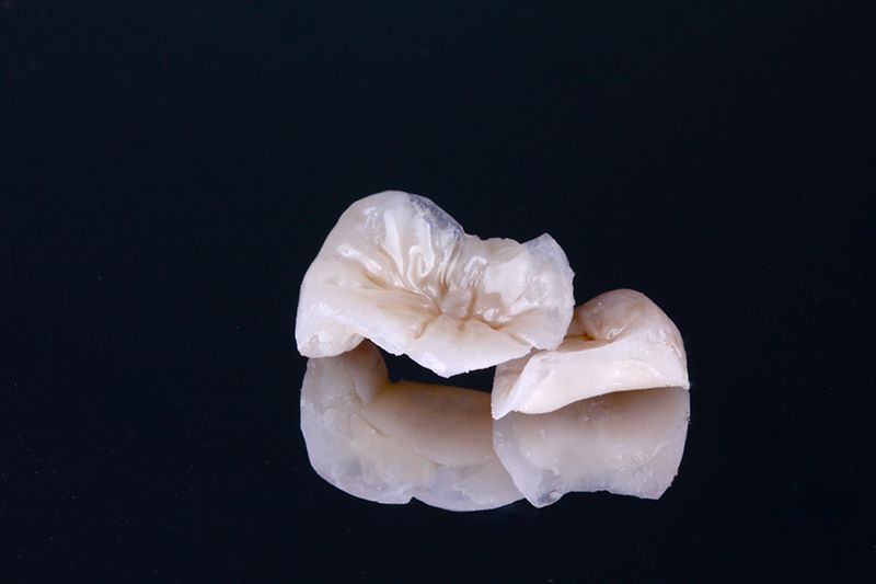 Incrustaciones Dentales