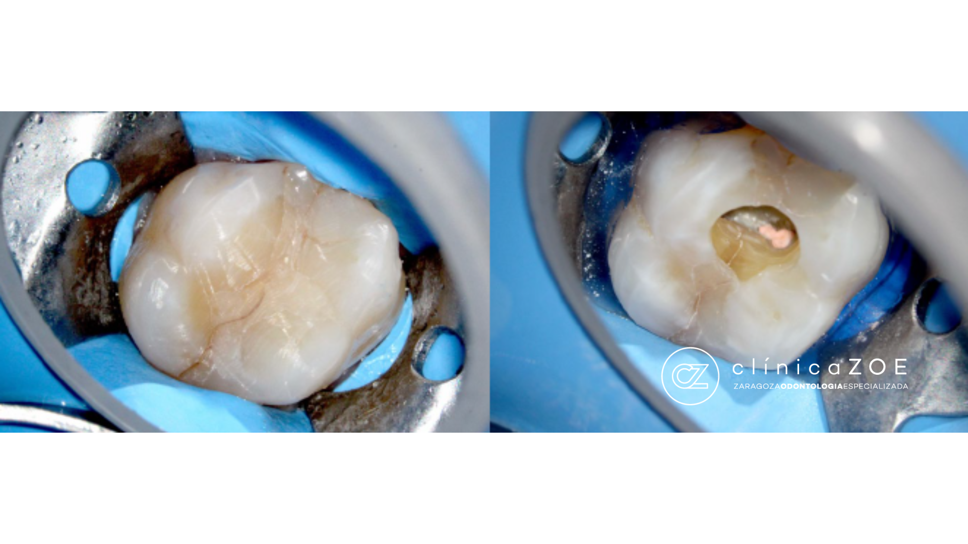 Diente fisurado Zaragoza
