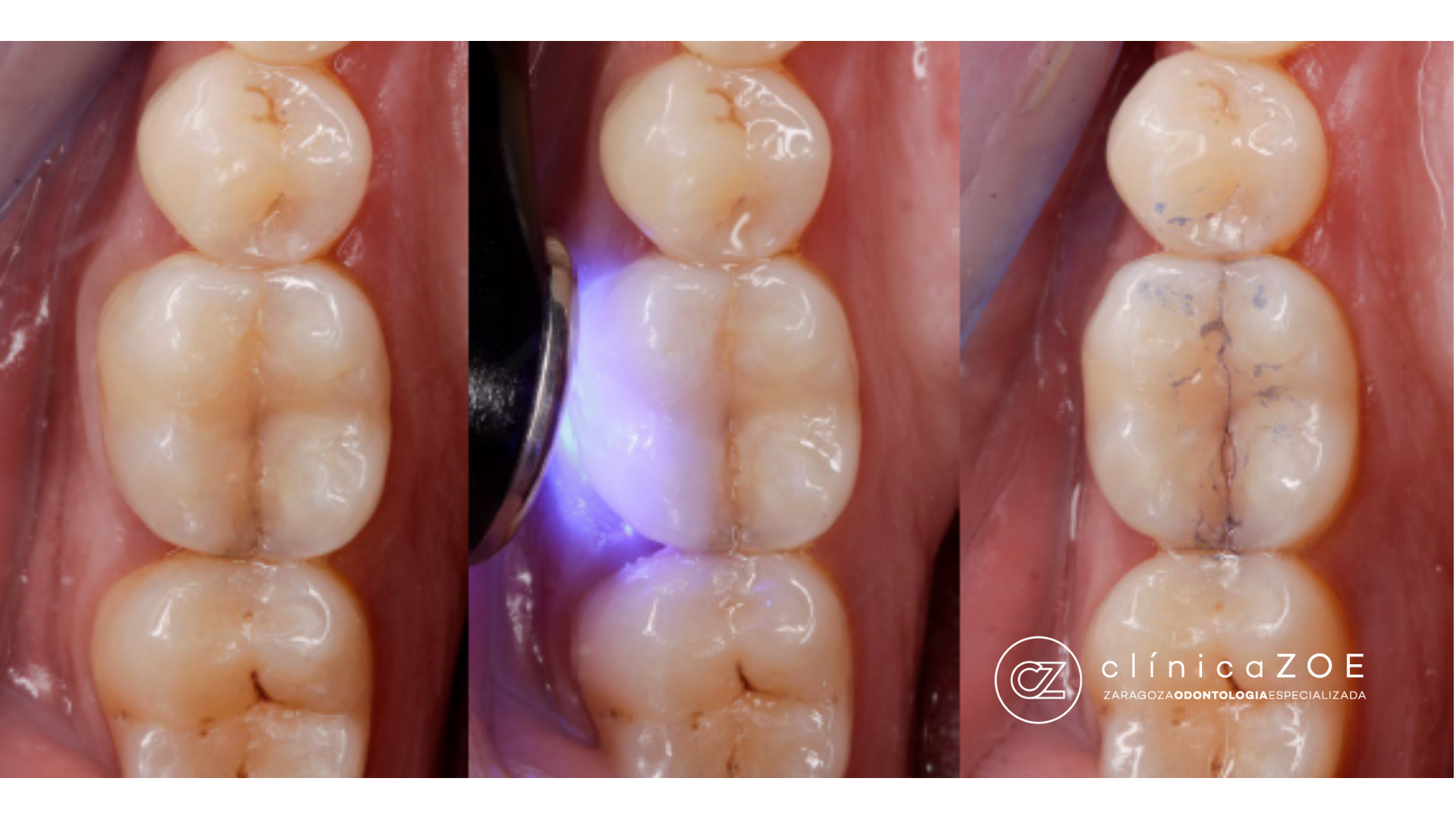 Diente fisurado Zaragoza