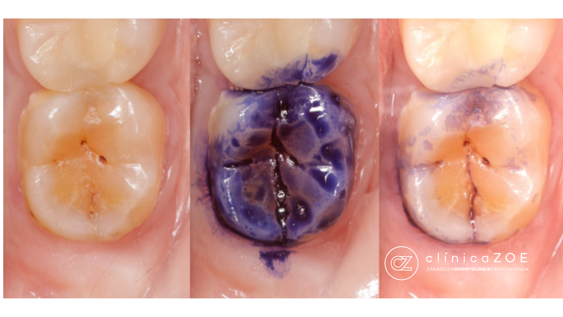 Diente fisurado Zaragoza